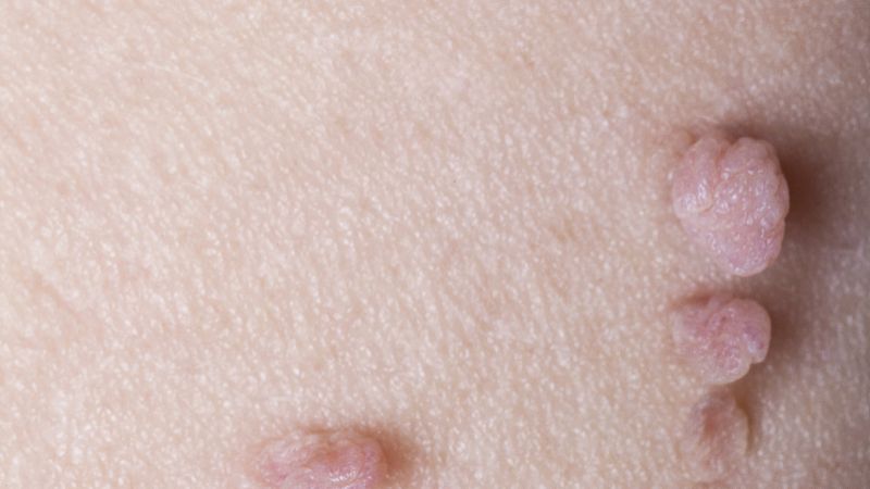 皮肤上长了扁平疣不去治疗都会有什么影响伤害?