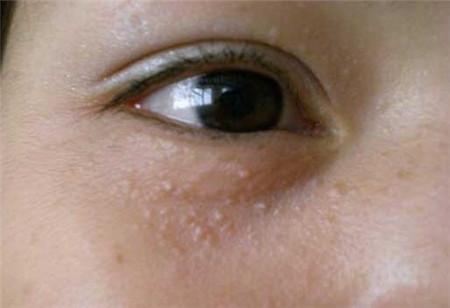 眼部出现扁平疣的原因及其症状表现特点是什么?