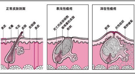 长了痤疮要怎么护理