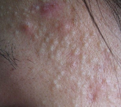 皮肤病-痤疮的种类