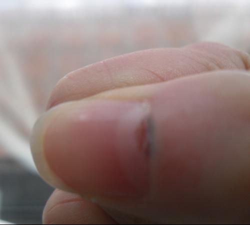 灰指甲症状图片