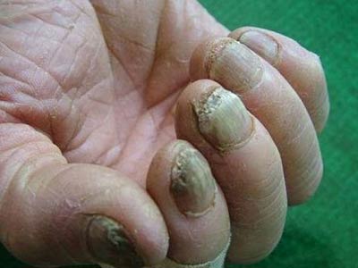 灰指甲引起的症状损害应当如何治疗才能及时消除?