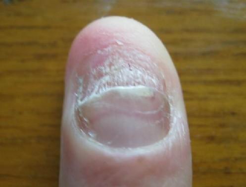 临床上出现灰指甲损害都是什么原因引起导致的?