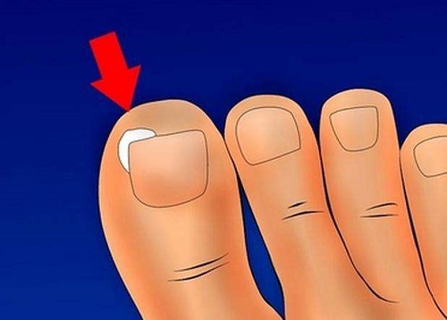 脚上的灰指甲初期都有哪些症状和表现呢?