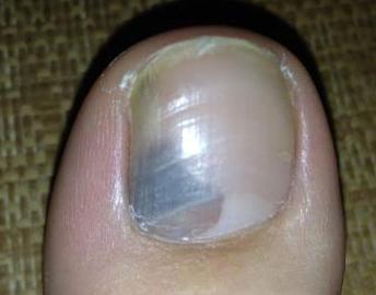 临床上灰指甲治疗应当注意的认识误区有哪些?