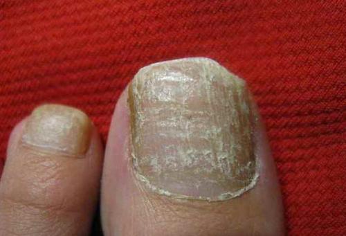 灰指甲患者如何正确的护理能够减少病损反复呢?