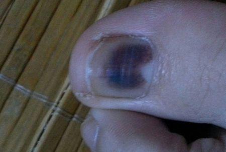 灰指甲典型的损害表现有哪些以及如何治疗去除呢?