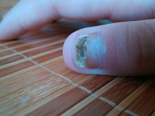 生活中指甲部位什么损害才是灰指甲的症状呢?
