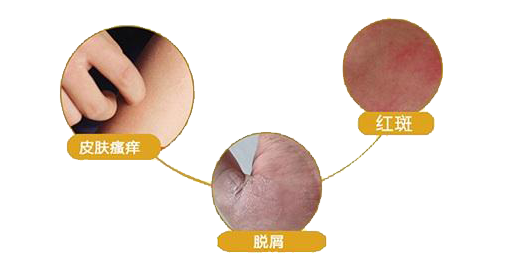 夏季生活中应当如何预防皮炎比较好呢?