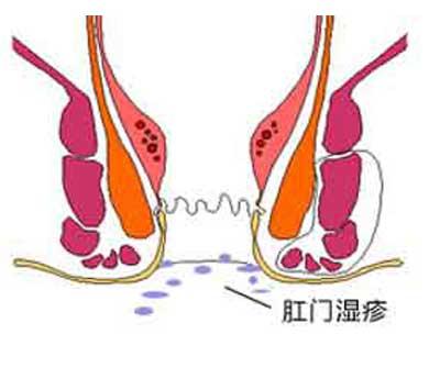 湿疹除了暴露部位还会出现在私密部位上吗?