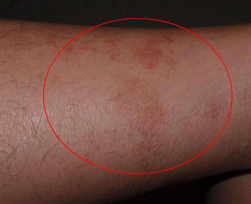 老年人得了皮肤湿疹应当怎么做才能减少症状和损害呢?