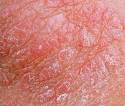 皮肤上的湿疹应当如何治疗才能有效的去除损害?