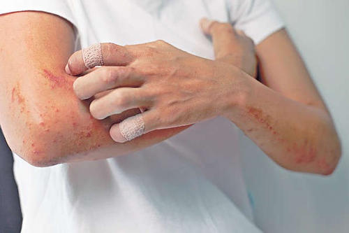 湿疹患者治疗上好转消退的表现是什么呢?
