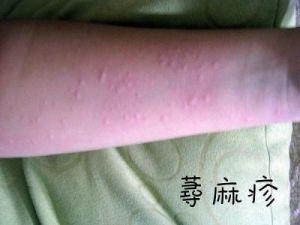 生活中能够引起皮肤荨麻疹的过敏源都有哪些呢?