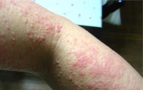 临床上都有哪些特殊原因和类型的荨麻疹呢?