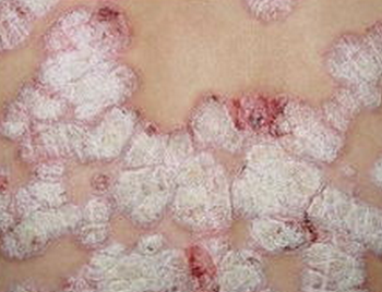 牛皮癣患者如何选择中药药浴方治疗缓解皮肤损害呢?